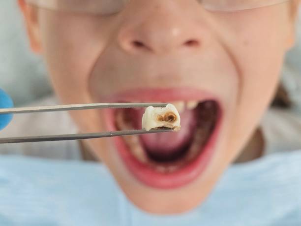Best Emergency Tooth Extraction in Aberdeen, MD